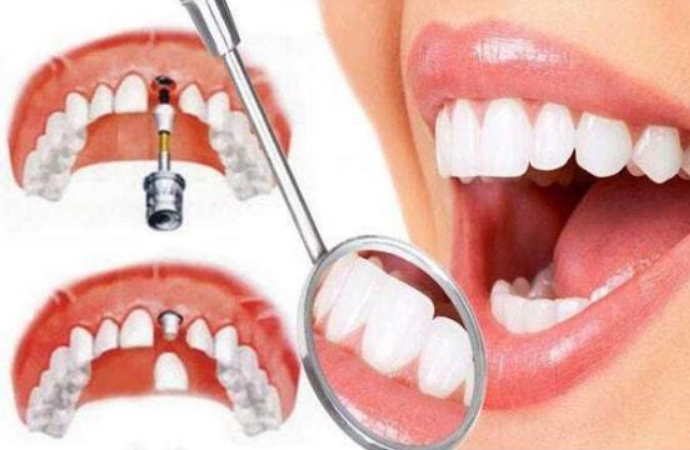 東莞生鮮配送中心為您普及:天生的牙齒和高價的種植牙哪個更好?